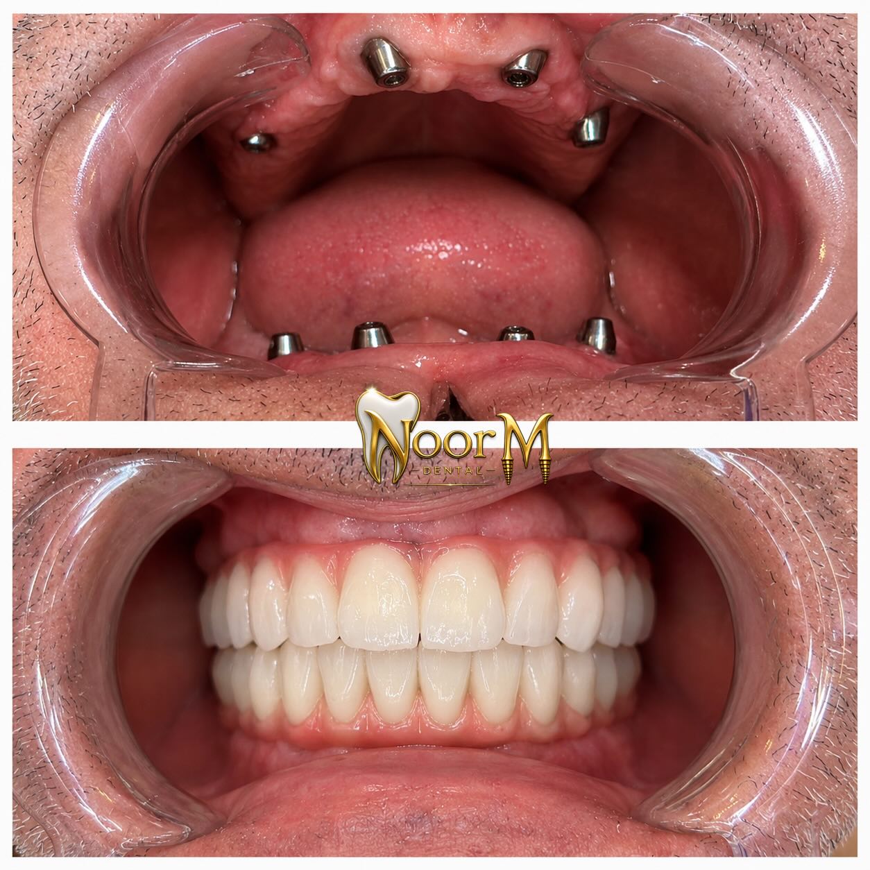 All on 6 Full Arch Restoration