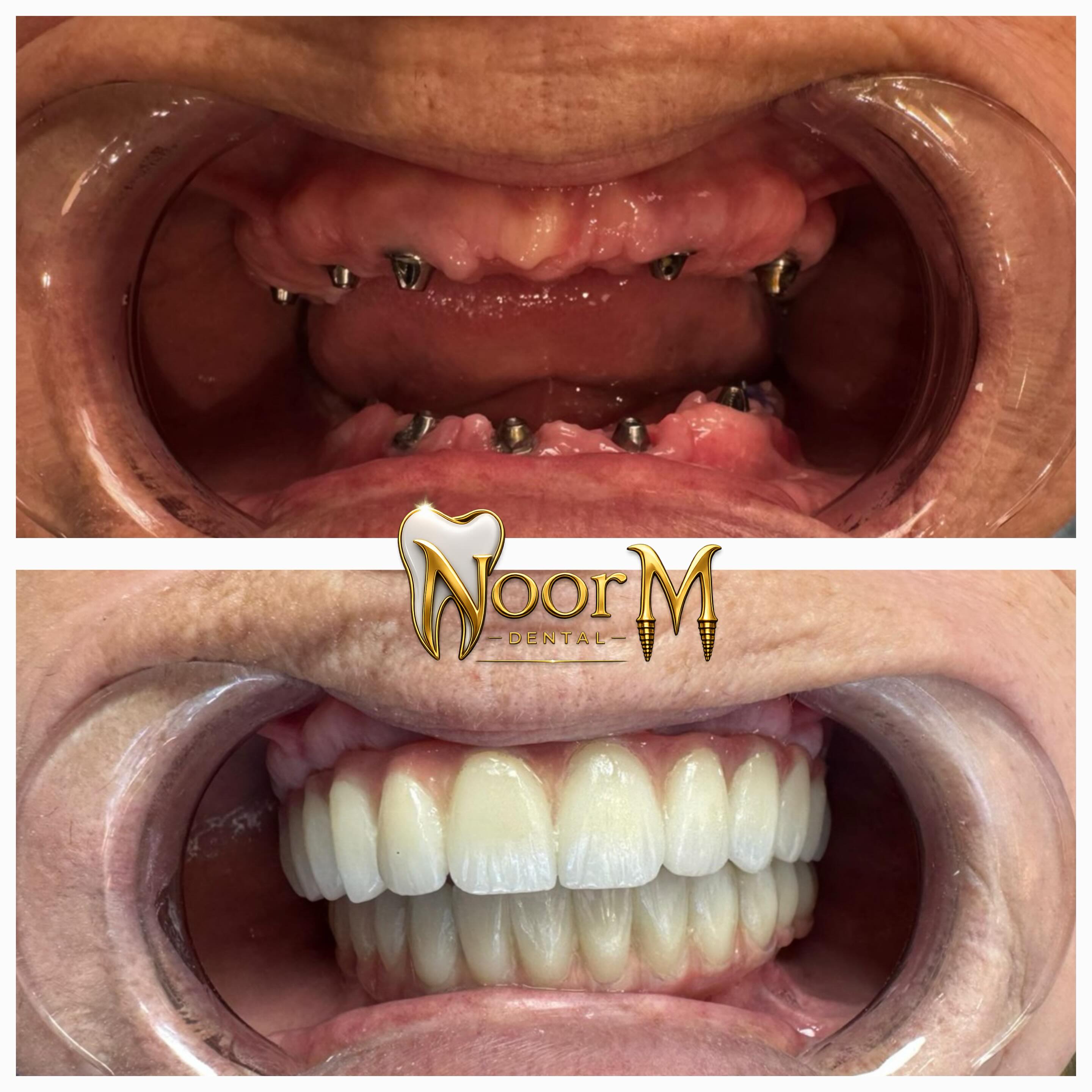 All-on-6 Full Arch Implant Rehabilitation