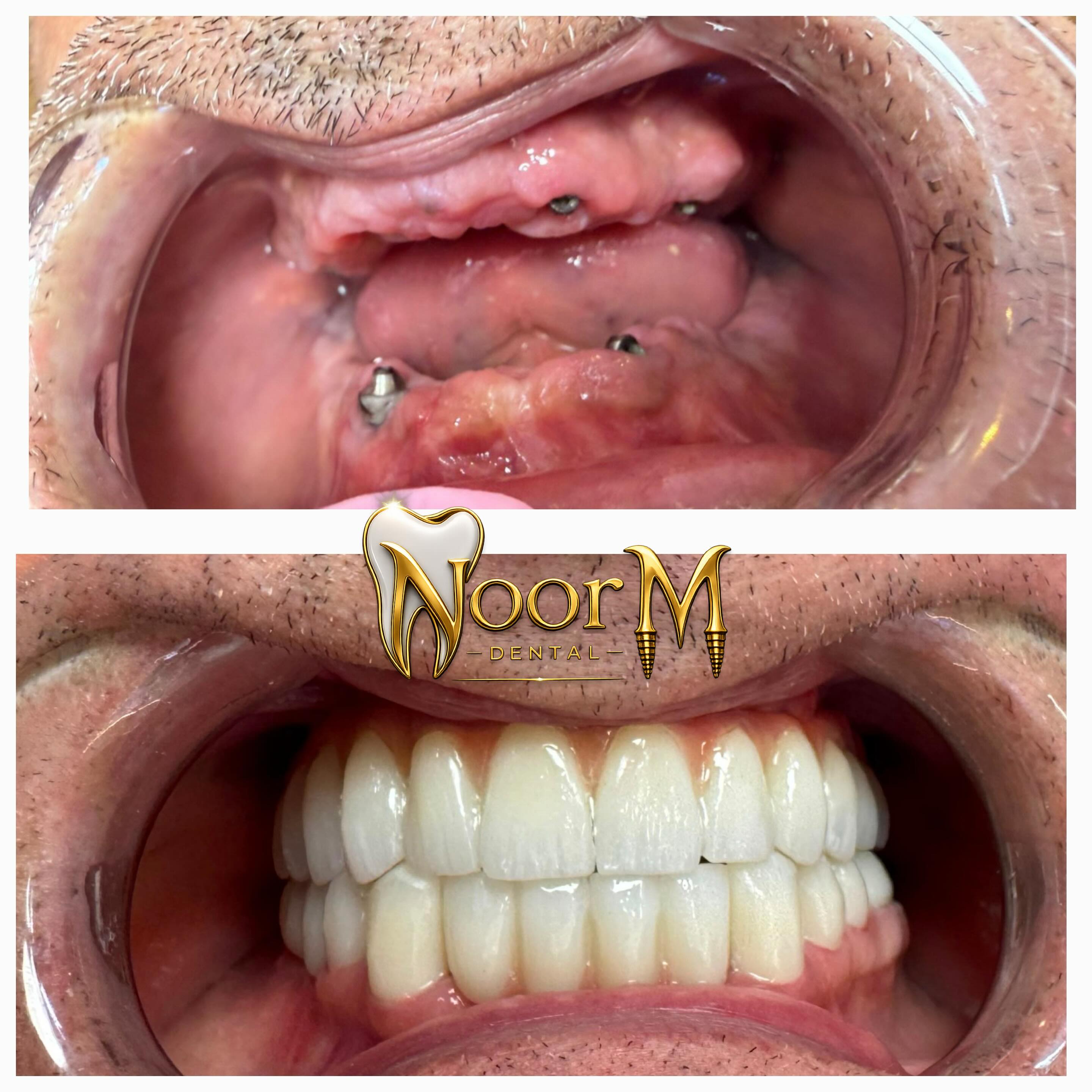 All-on-4 Full Mouth Restoration