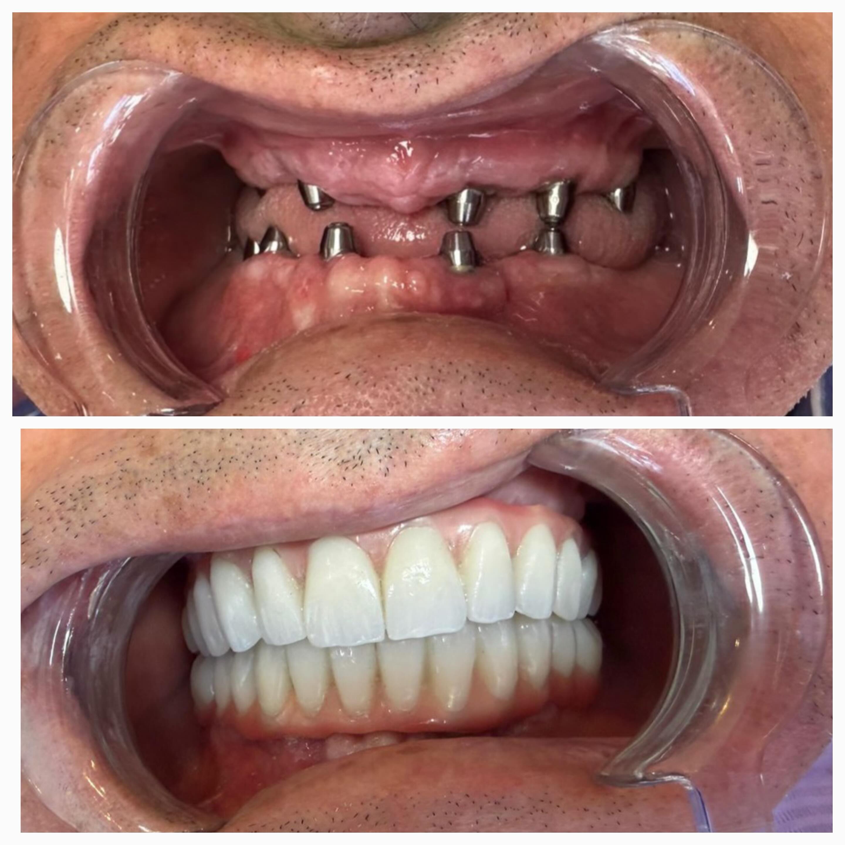 All-on-6 Bimaxillary Reconstruction